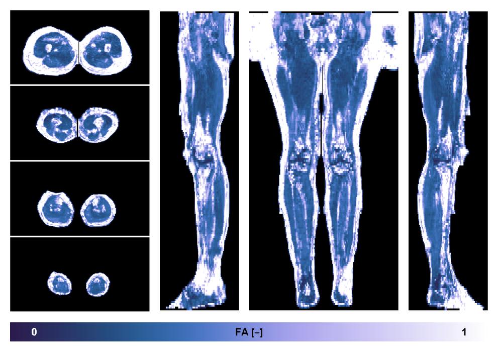 IVIM corrected whole leg muscle fractional anisotropy obtained from diffusion tensor imaging.